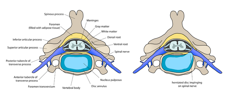 vertebra in cross section also showing herniation